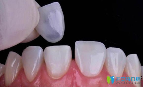 全瓷牙貼面修復(fù)效果圖