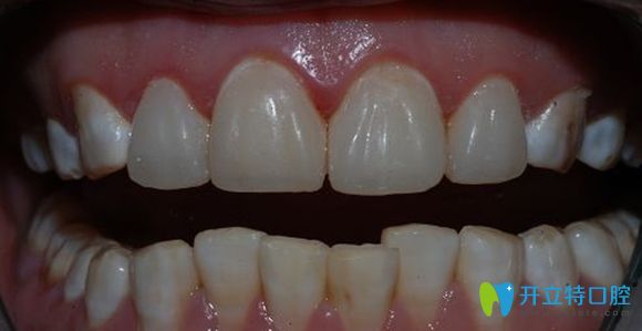 樹脂牙齒貼面修復(fù)效果圖