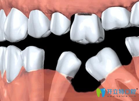 缺牙不種的危害