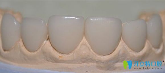 聚合瓷貼面修復(fù)效果圖展示