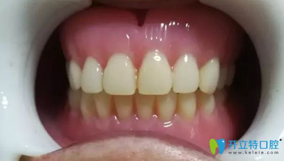全口bps吸附性義齒佩戴效果圖