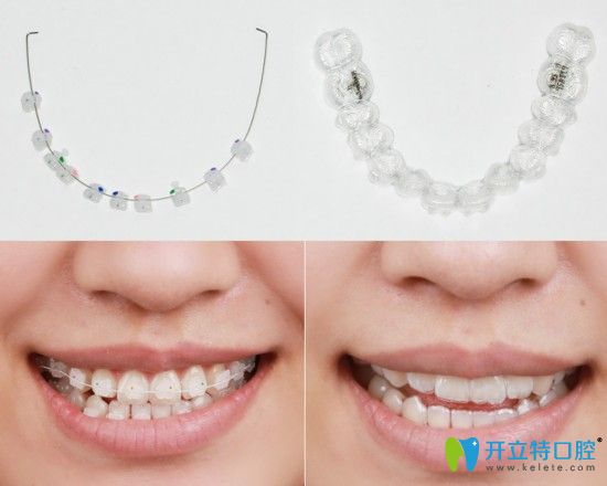 陶瓷托槽矯正和隱形矯正區(qū)別