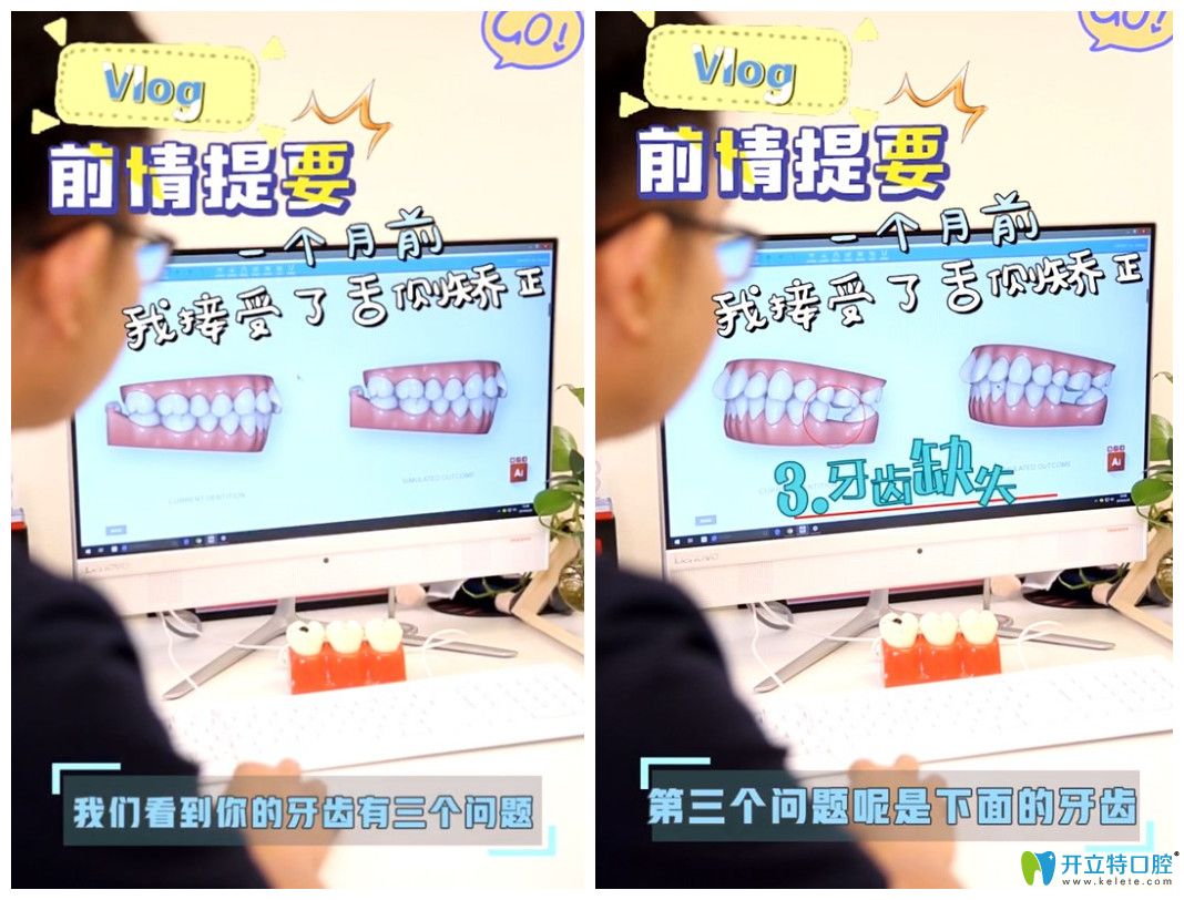 來看找上海維樂口腔楊國平做舌側(cè)矯正的人是怎么評價(jià)他的