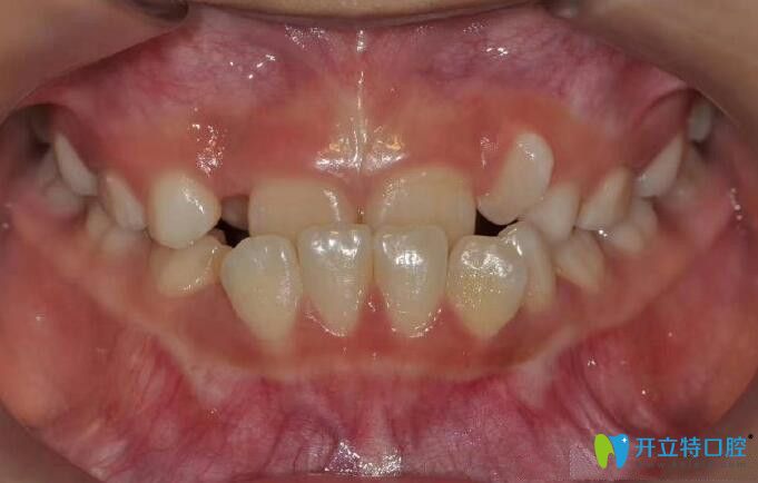 地包天牙齒在重慶茁悅口腔矯正前