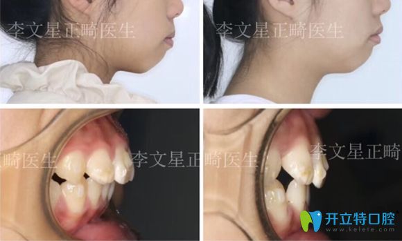 成都茁悅口腔李文星做兒童牙齒矯正案例 成都茁悅口腔李文星做兒童牙齒矯正案例