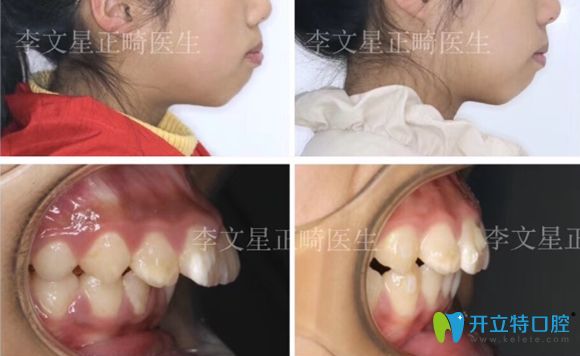 成都茁悅口腔兒牙矯正前后效果 成都茁悅口腔兒牙矯正前后效果