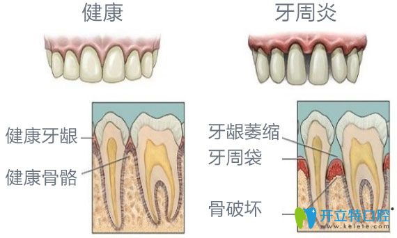 健康牙齒與牙槽骨萎縮牙齒之間對比圖