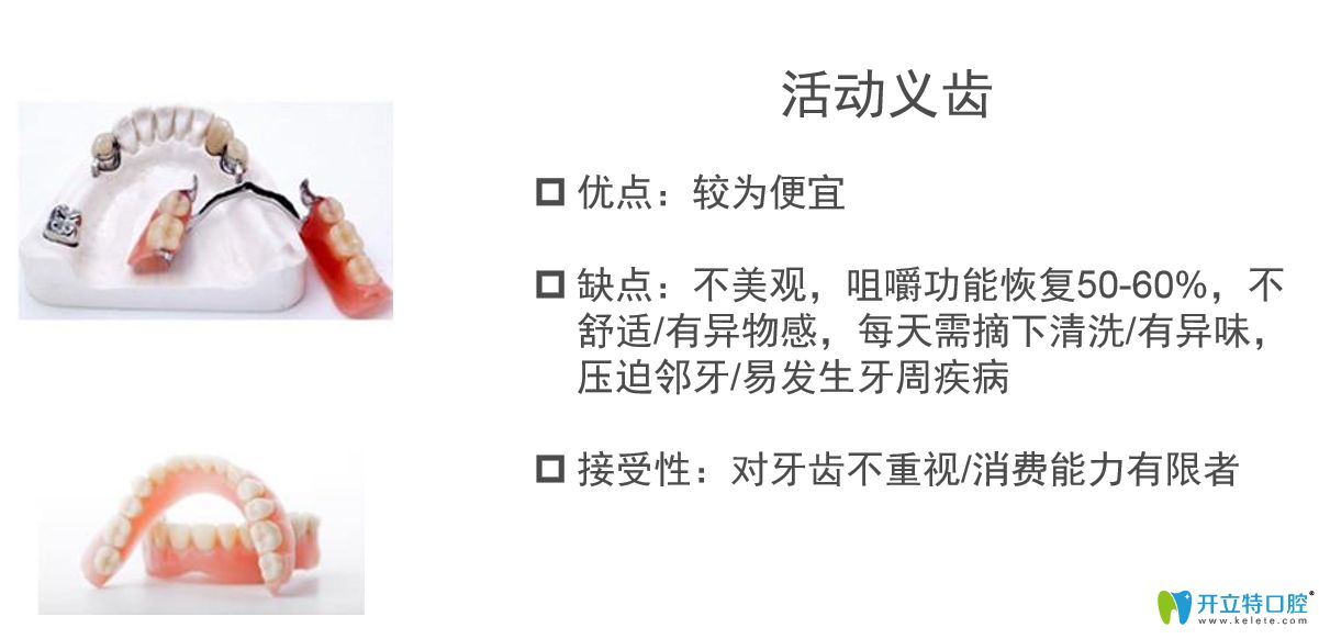 活動假牙優(yōu)缺點