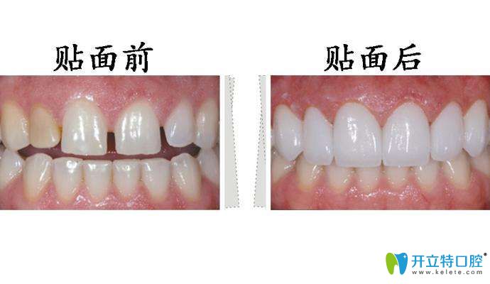 做完牙齒貼面前后對(duì)比圖