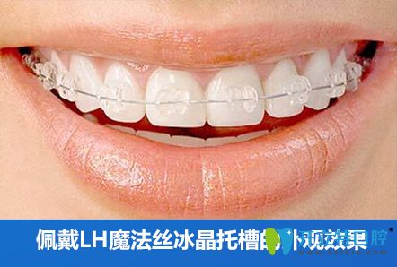 陶瓷托槽半隱形矯正圖