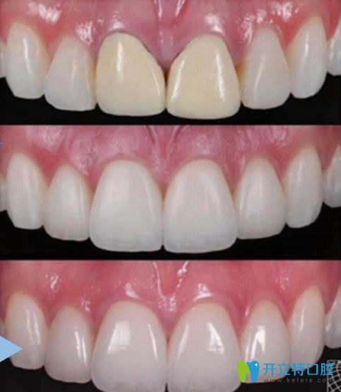 瑾帆口腔瓷貼面的案例