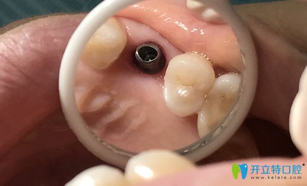 種牙過程中的放大圖