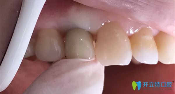 牙齒帶好牙冠的照片