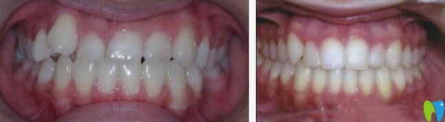 戴隱適美IGO牙套矯正反頜效果