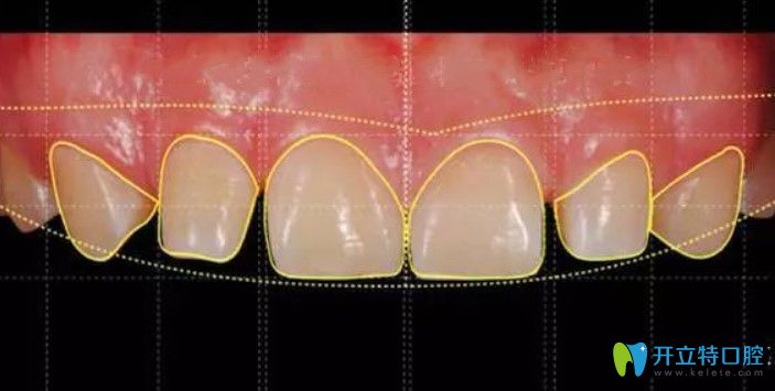 趙紫青表示牙齒貼面要考慮美學(xué)因素