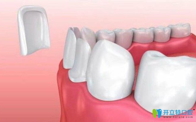 趙紫青醫(yī)生解析：牙齒貼面多久需要更換