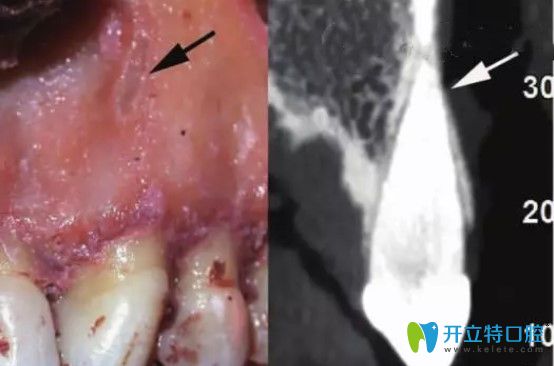 骨開窗牙齒及CT照片