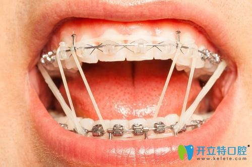 what？有人疑惑正畸橡皮筋吃飯刷牙時還得拿下來么