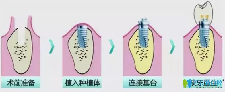 即拔即種和種植牙的區(qū)別,其實(shí)是對(duì)的時(shí)機(jī)遇見對(duì)的牙齒條件