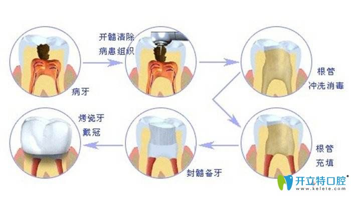 根管治療的過程