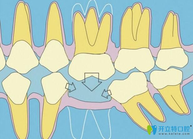 種植牙間隙不夠,正畸關(guān)閉或推開間隙來(lái)救,注意磨牙慎選