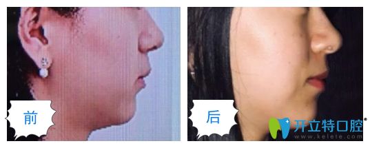 長(zhǎng)沙美奧口腔隱形矯正虎牙臉型變化