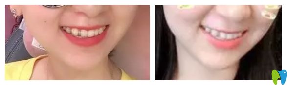 隱適美隱形虎牙矯正前后