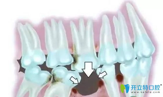 缺失的危害示意圖