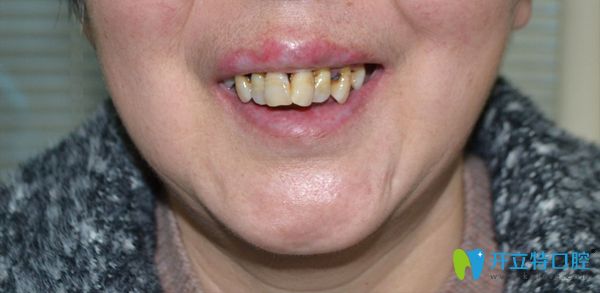 劉阿姨牙齒之前樣子
