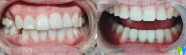 隱適美矯正齙牙效果