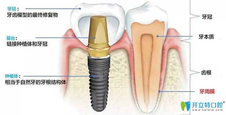 種植牙構造分布圖
