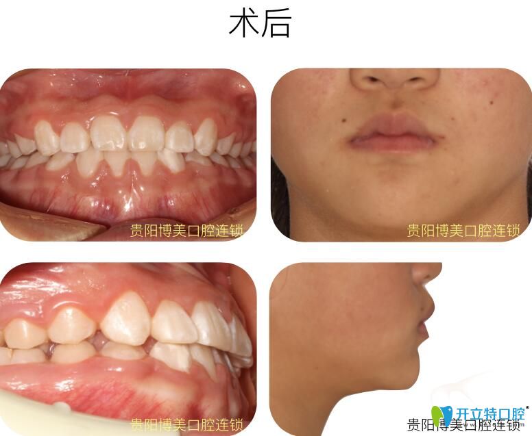 前牙反頜在<!--<i data=20240703-sp></i>-->口腔做牙齒矯正后照片 前牙反頜在<!--<i data=20240703-sp></i>-->口腔做牙齒矯正后照片