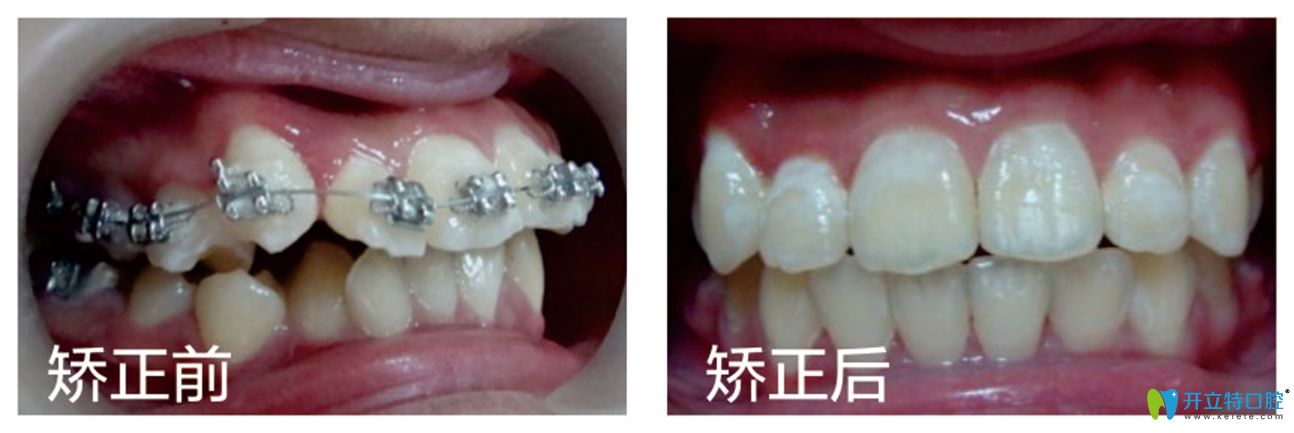 修大夫口腔齙牙矯正前后效果對比圖