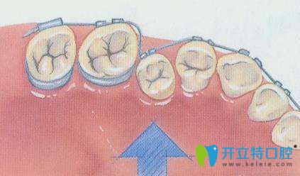 牙齒矯正示意圖 牙齒矯正示意圖