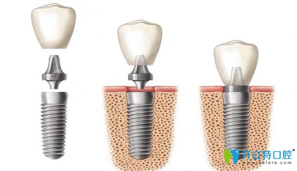 雅悅齒科韓國(guó)紐百特種植牙
