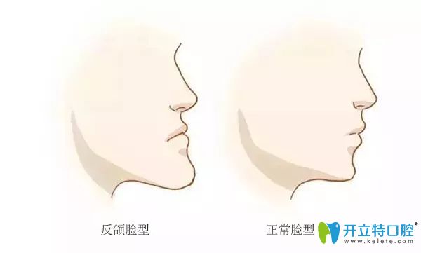 反頜臉型 反頜臉型