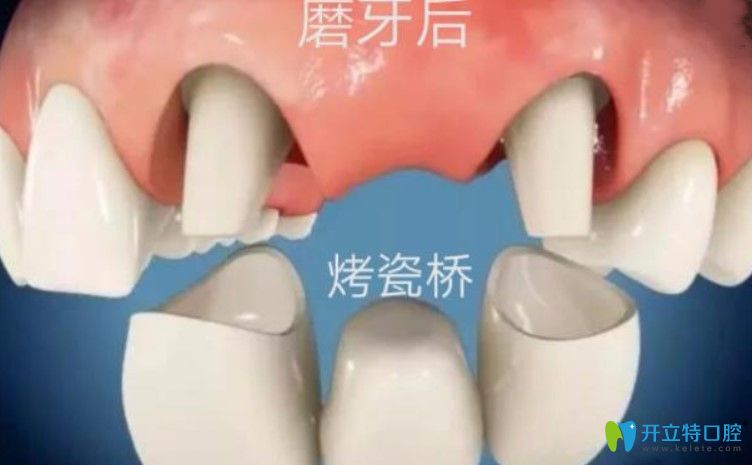剛戴上全瓷牙咬東西疼是咋回事？趕緊戳進(jìn)來(lái)看看吧