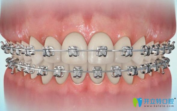 維樂(lè)口腔金屬托槽矯正