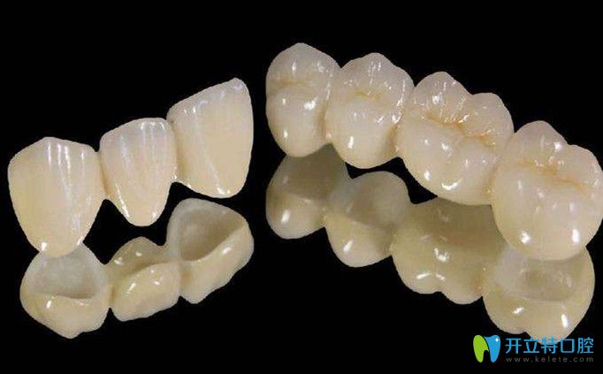 傅氏口腔全瓷冠