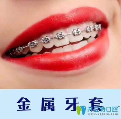 重慶維樂口腔金屬牙套