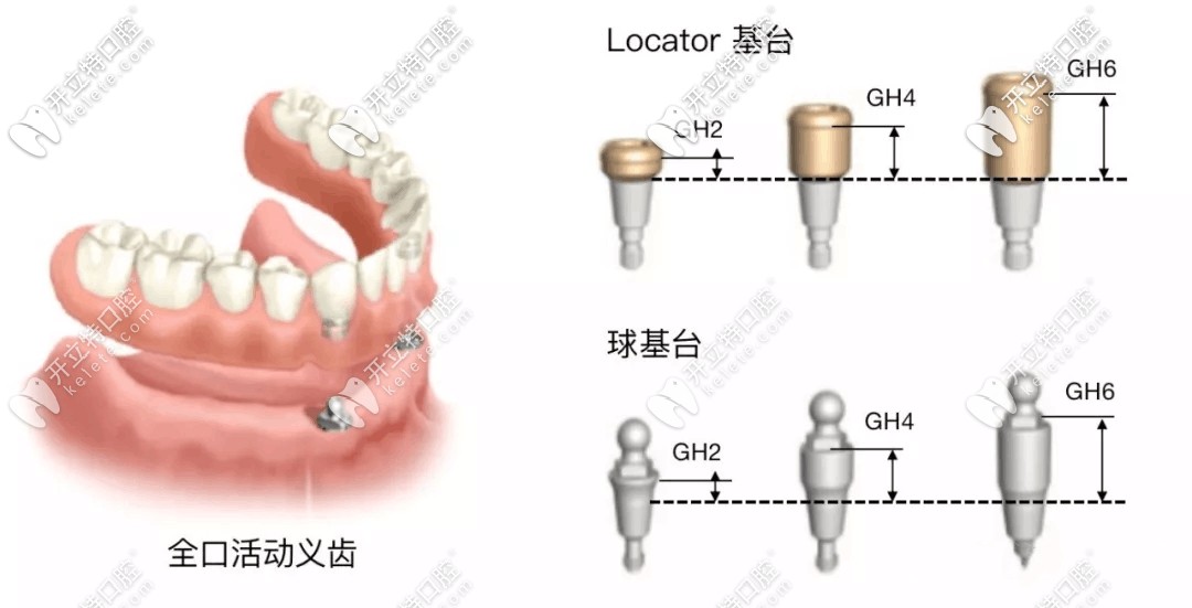 locator基臺(tái)和球帽基臺(tái)區(qū)別圖