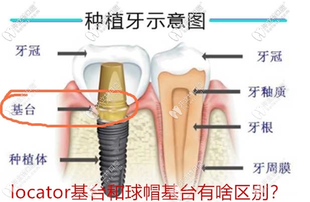 看這簡(jiǎn)單的幾張圖就能明白locator基臺(tái)和球帽基臺(tái)的區(qū)別