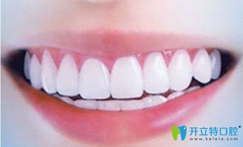 美白牙齒活動詳情