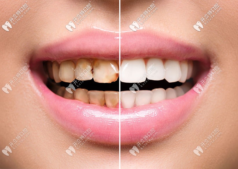 牙齒冷光美白前后對比照