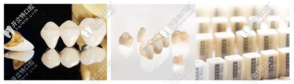 牙齒缺損了做烤瓷牙還是瓷?？贪?做過的說說哪個(gè)好