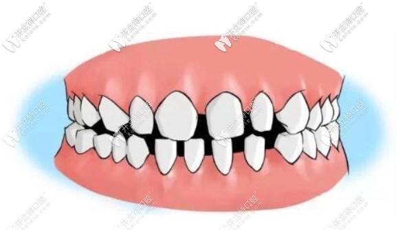 我的牙縫很大，到底需不需要補(bǔ)呀
