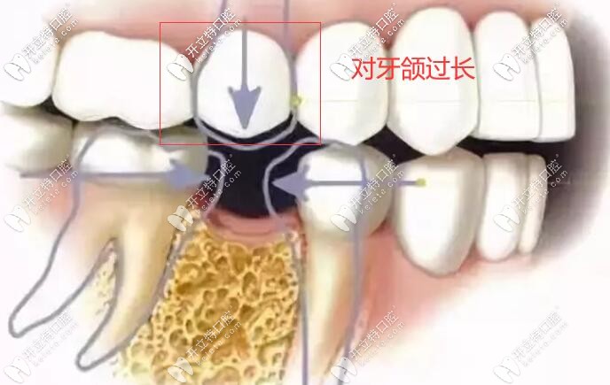 對面牙齒過長,上下咬合空間不夠怎么做種植牙?