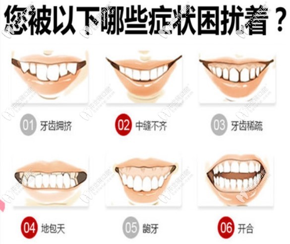 圖示牙齒情況都可以通過(guò)gac托槽矯正