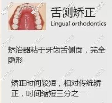 舌側(cè)矯正優(yōu)點(diǎn)