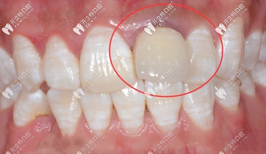 將過(guò)渡義齒用螺絲固位能方便檢查種植體的穩(wěn)定性